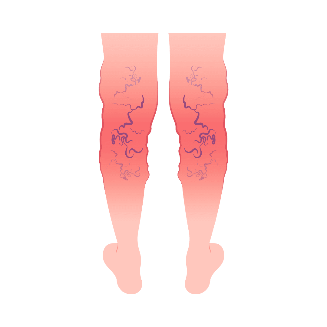 Варикозное расширение вен