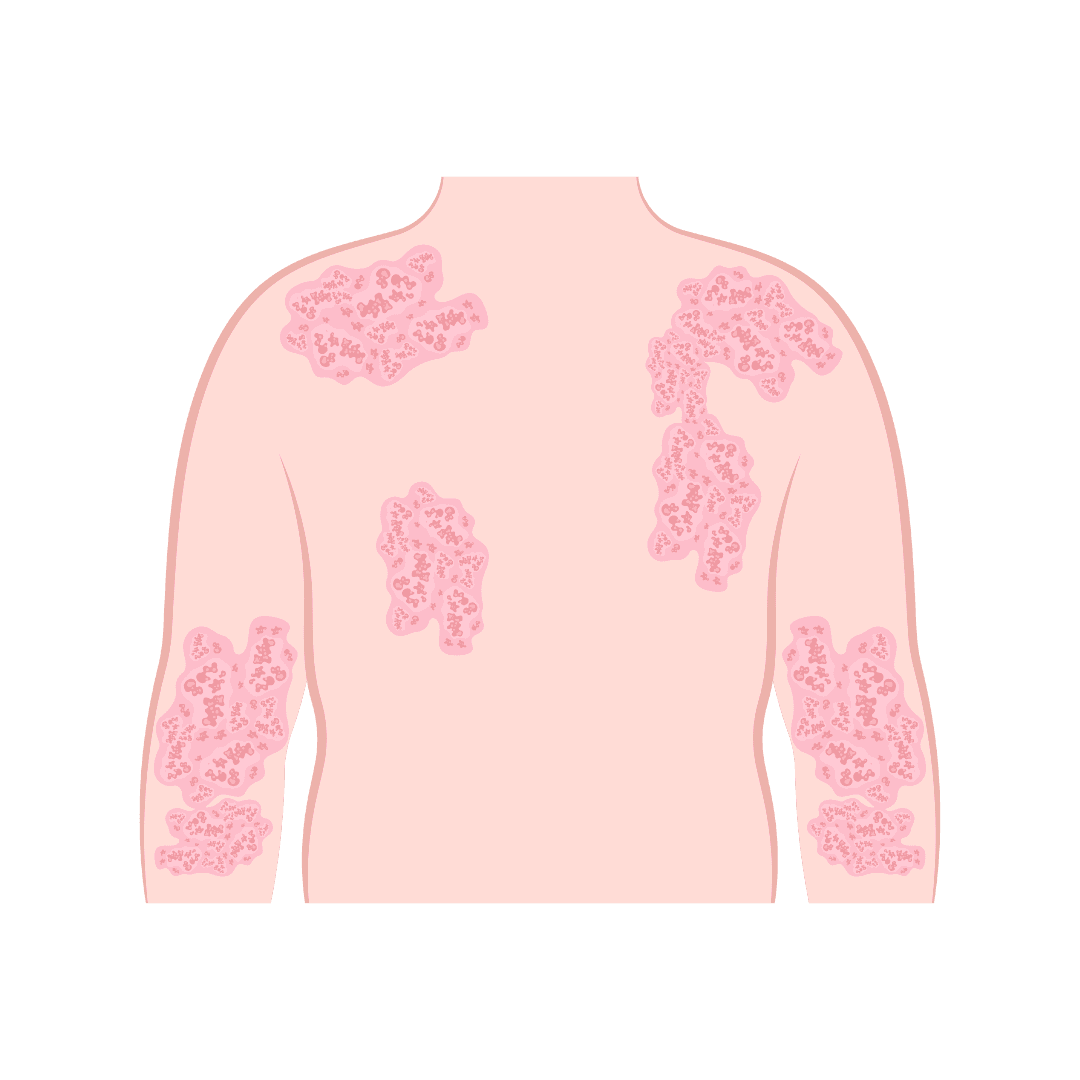 Атопический дерматит и экзема