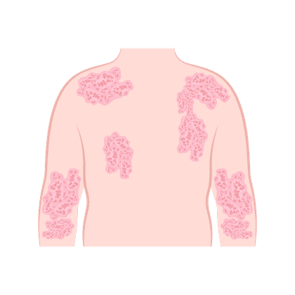 Атопический дерматит и экзема