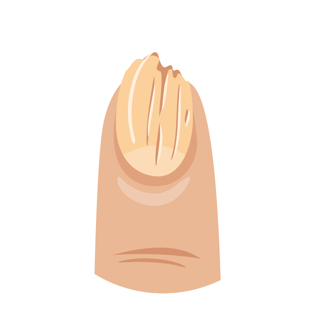 Ломкость ногтей